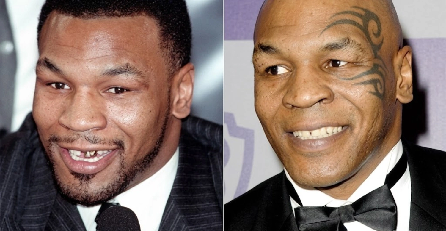 Celebrity Dental Implants Before and After7